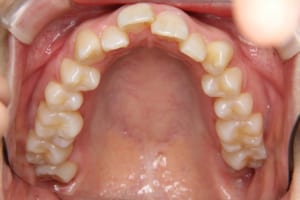 前歯部の叢生。左右智歯が生えてきています。
